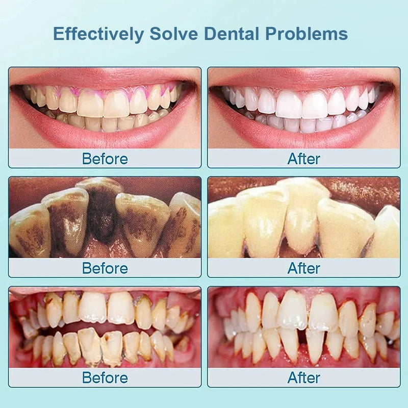 Ultrasonic Dental Scaler For Teeth Tartar - likeinstore