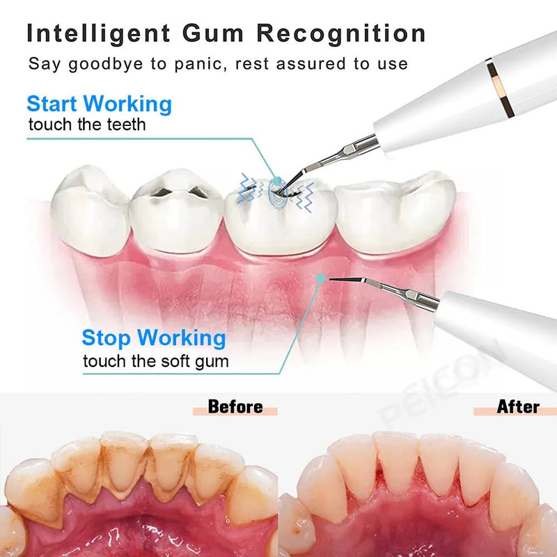 Ultrasonic Dental Scaler For Teeth Tartar - likeinstore
